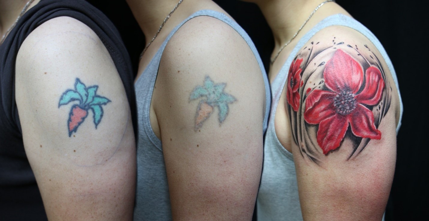 Laser Tattoo Removal